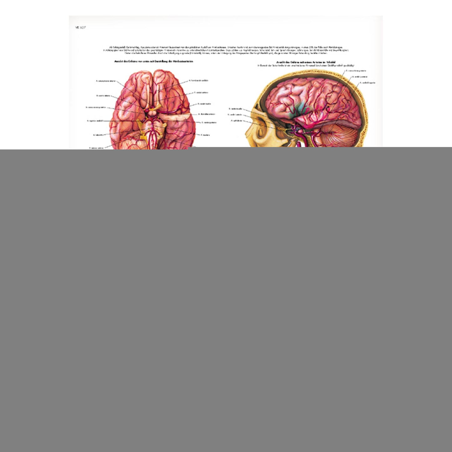 Stroke Wall Chart Depicts Pathological Changes That Occur During A Stroke In A Clear Manner