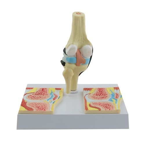 Rheumatic Knee Joint Model In Longitudinal Section