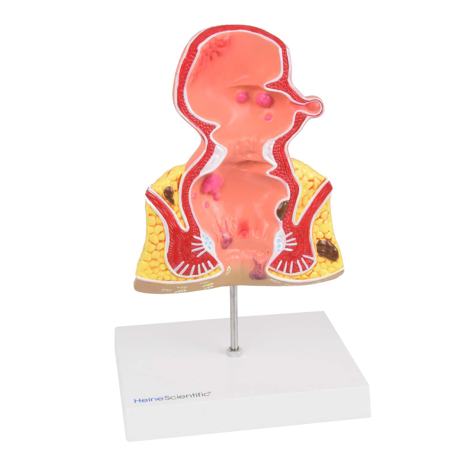 Rectum Model With Pathologies From Heinescientific